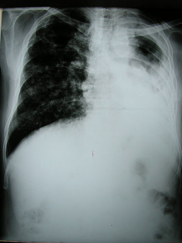 TB+Shot+Reactions ... positive tb skin test tb shot reactions http www baby wise co